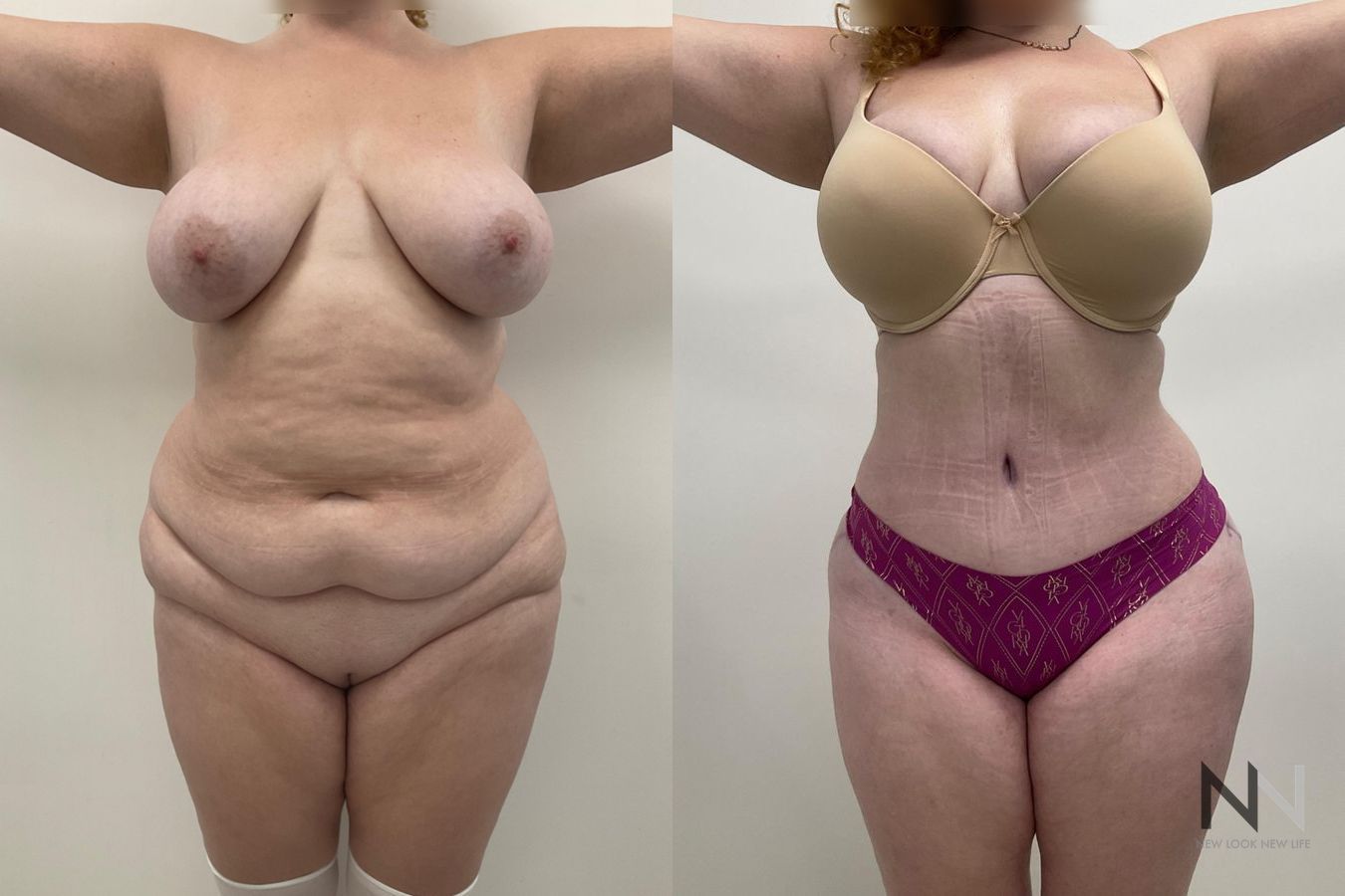 Abdominal contour improvement after mommy makeover