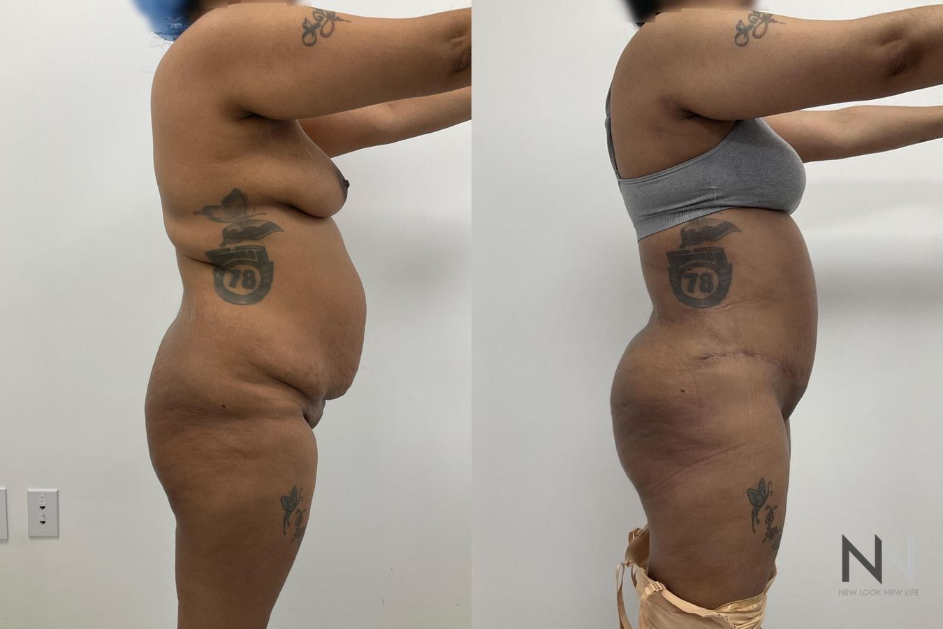 Before and after mommy makeover six months results - Angle 4