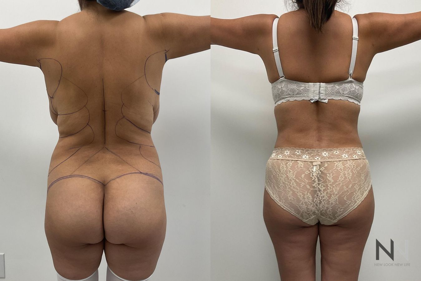 Before and after mommy makeover eight months results - Angle 2