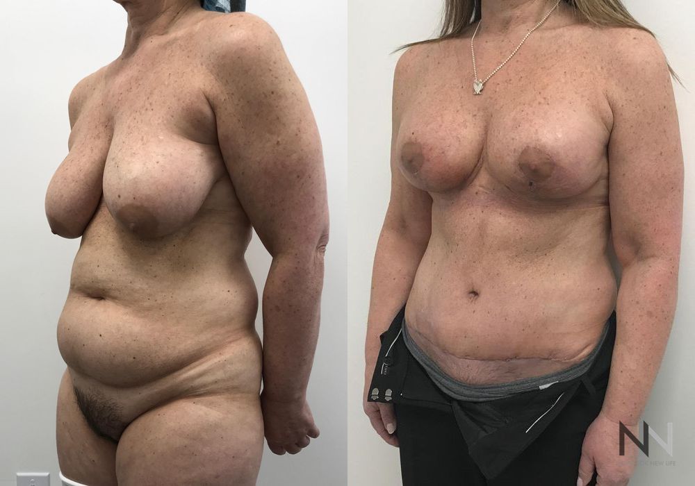 Mommy Makeover - Case 1897