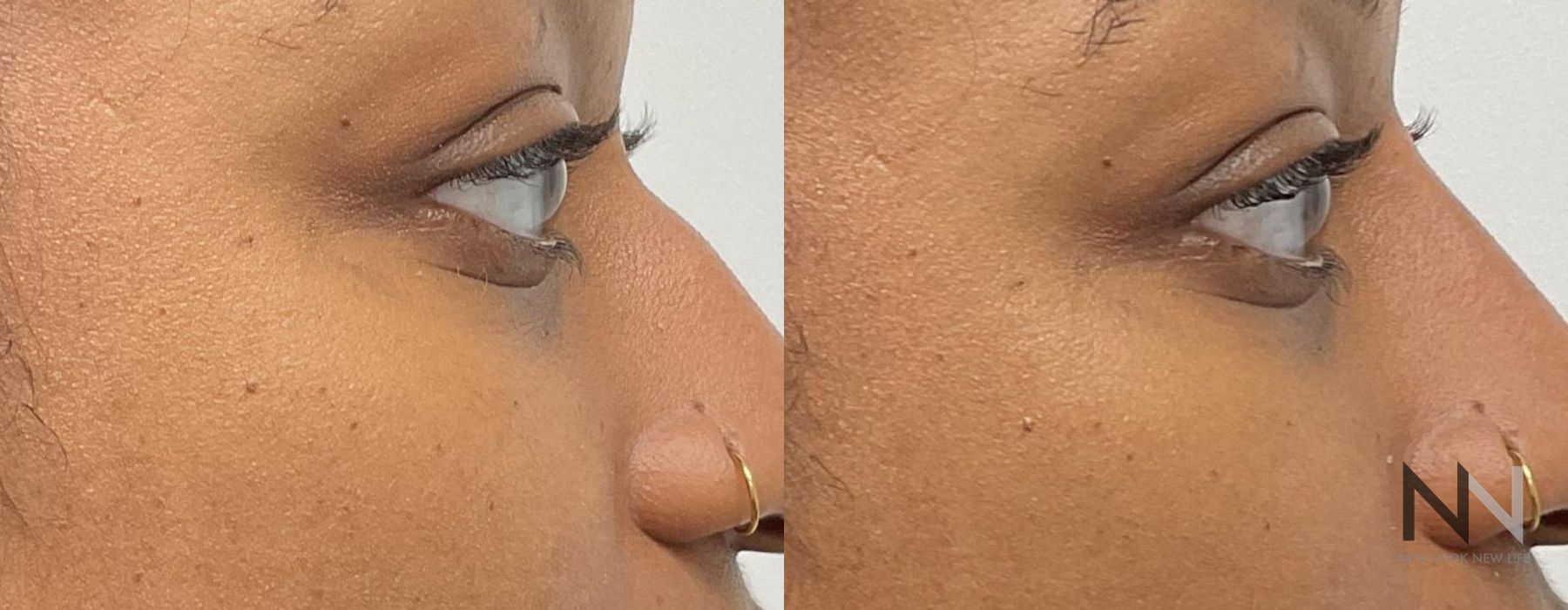 Nasal Contouring - Thumbnail 2