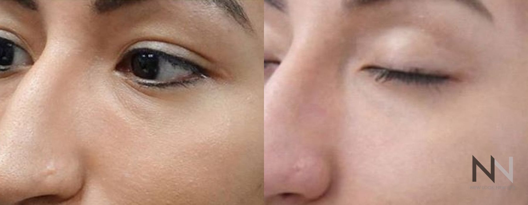 Nasal Contouring - Case 2246