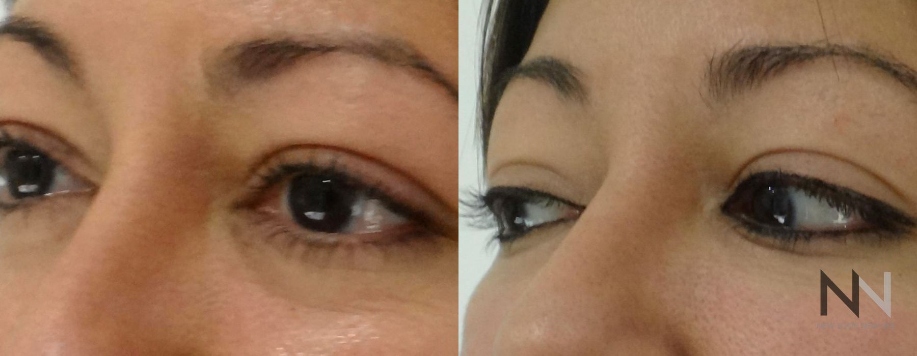 Nasal Contouring - Case 1714