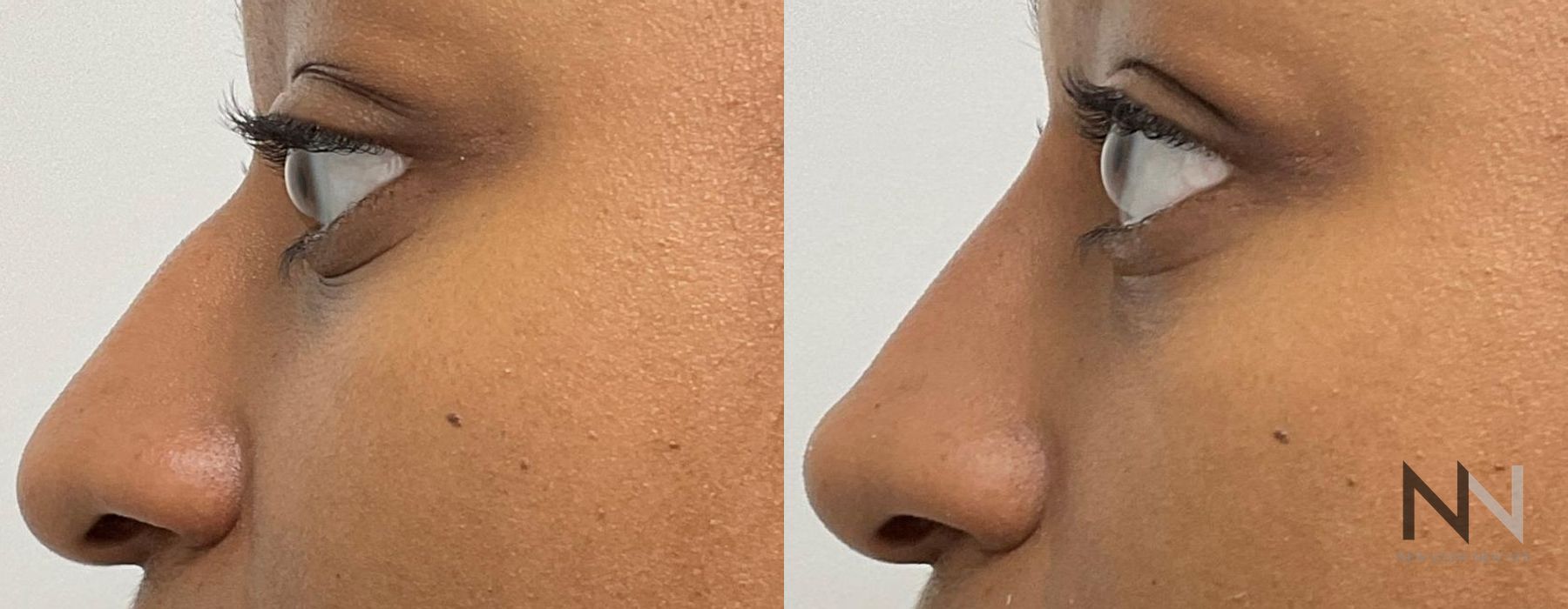 Nasal Contouring - Case 2248