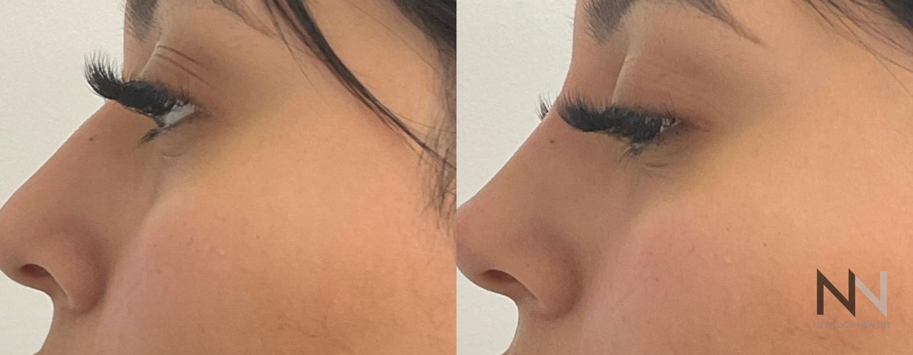 Nasal Contouring - Case 2247