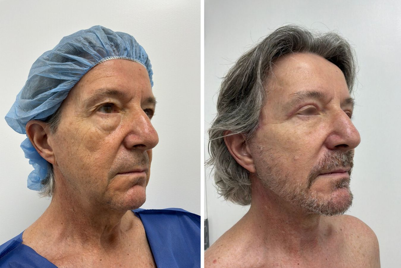 Before-and-after photos of a male neck lift with platysmaplasty by Dr. Claudia Kim showing improved neck and jawline definition.