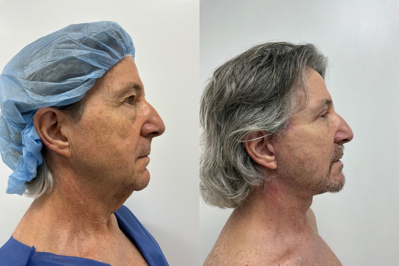 Before-and-after photos of a male neck lift with platysmaplasty by Dr. Claudia Kim showing improved neck and jawline definition. - Angle 2