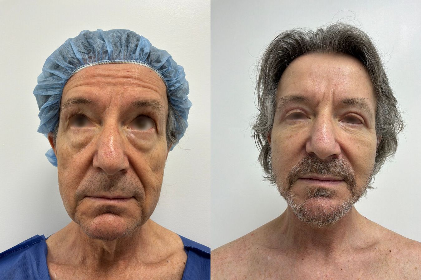 Before-and-after photos of a male neck lift with platysmaplasty by Dr. Claudia Kim showing improved neck and jawline definition. - Angle 3