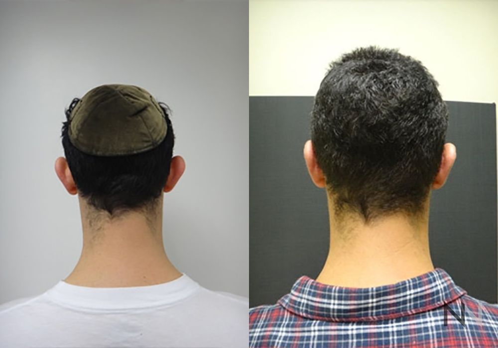 Otoplasty - Case 2183