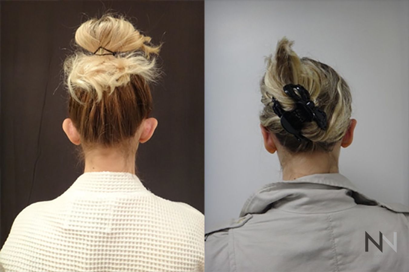 Ear pinning surgery showing reduced ear protrusion