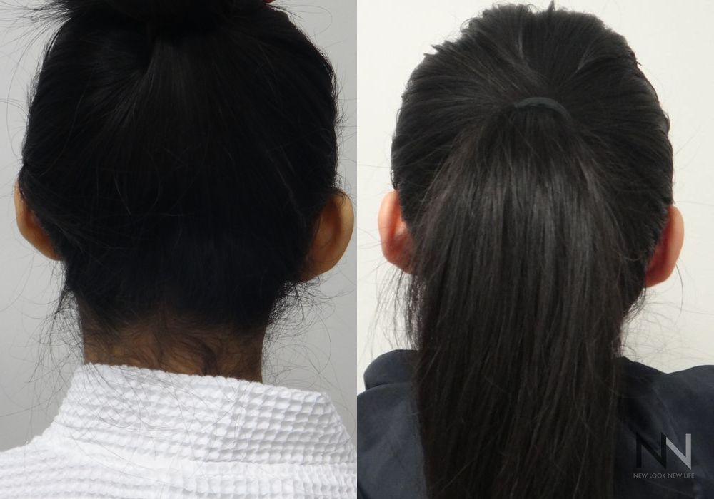 Otoplasty - Case 2185