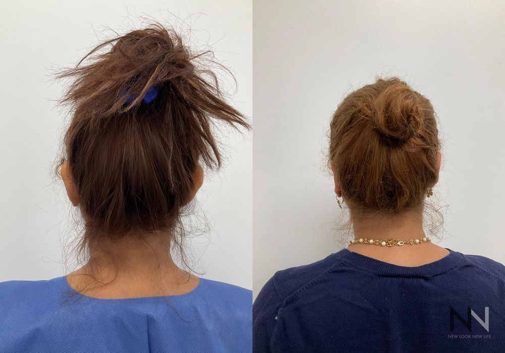 Otoplasty - Case 2186