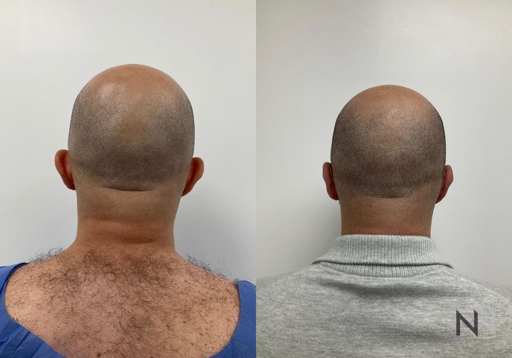 Otoplasty - Case 1657