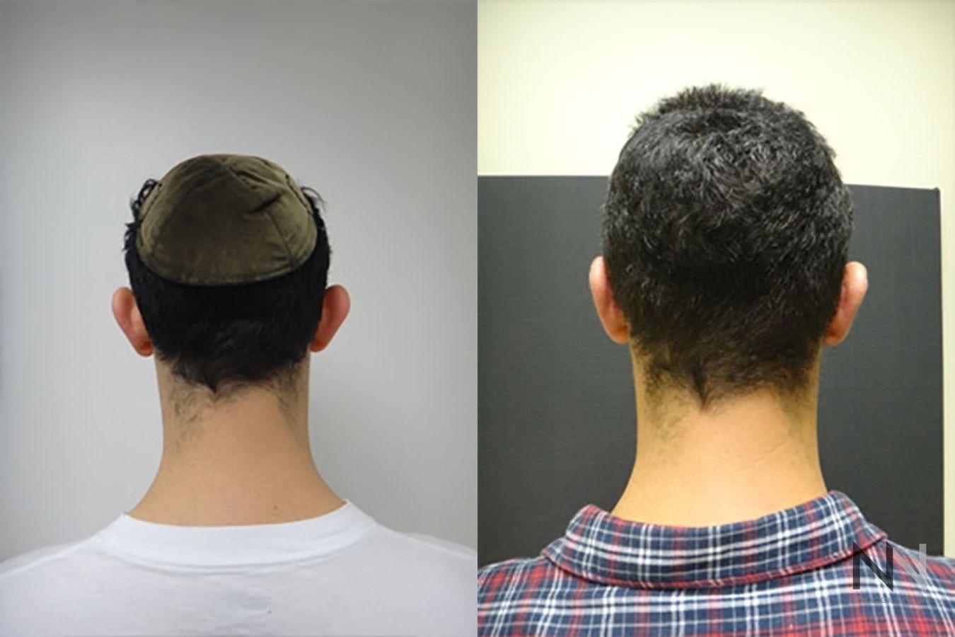 Otoplasty before and after alignment improvement