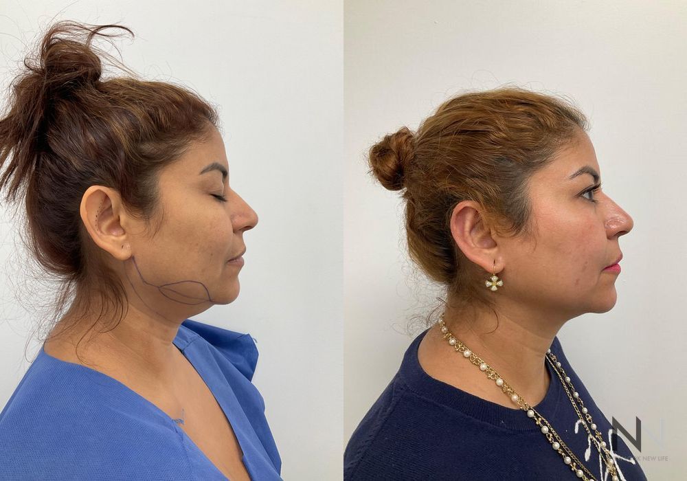 Otoplasty - Case 1656