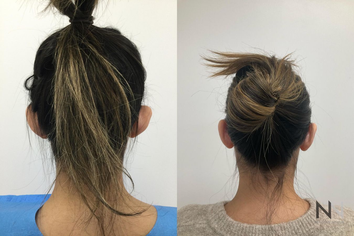 Otoplasty before and after back view comparison