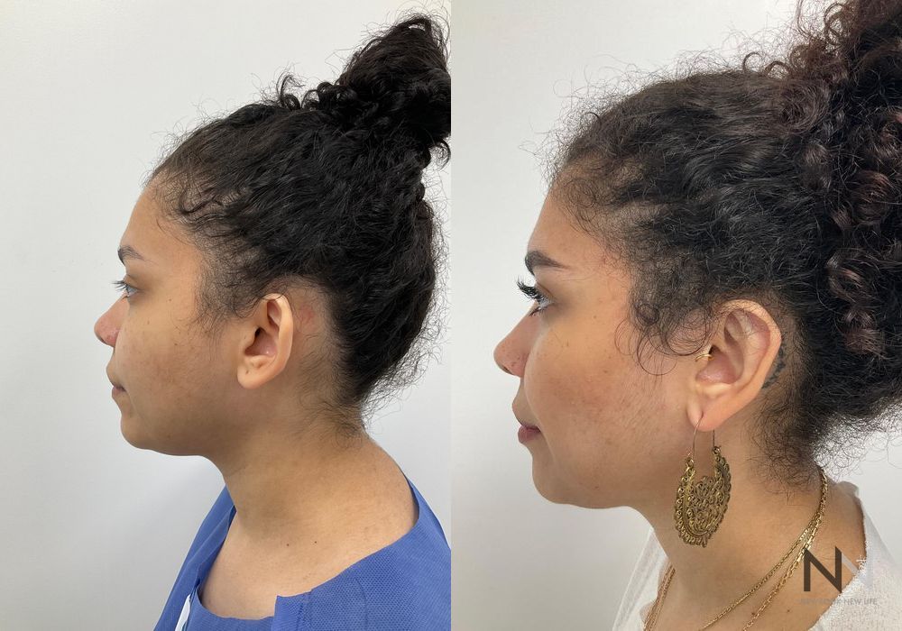 Otoplasty - Thumbnail 2