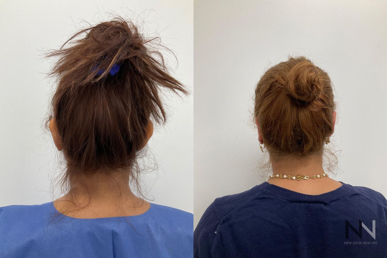 Jawline contour improvement after chin liposuction - Angle 2