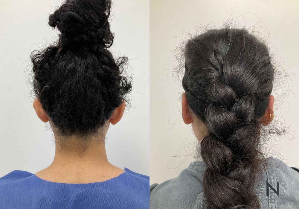 Otoplasty - Case 1658