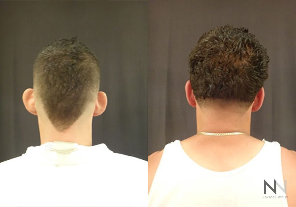 Otoplasty - Case 1651