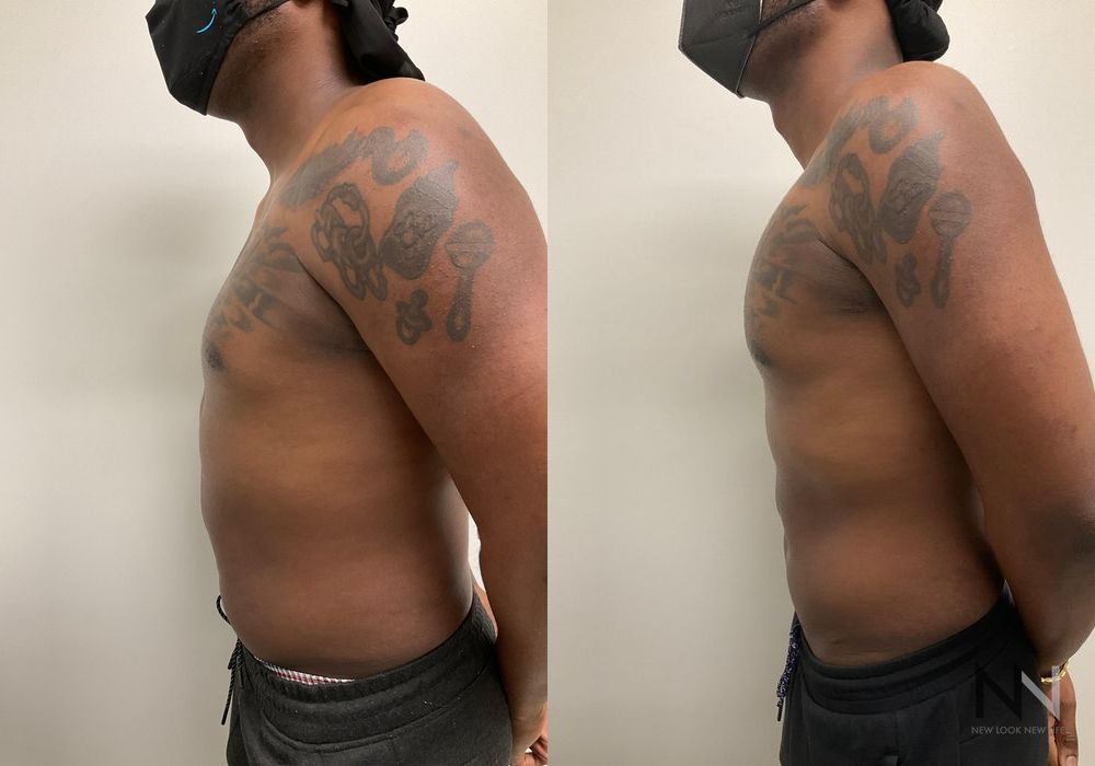Pec Implants - Thumbnail 3