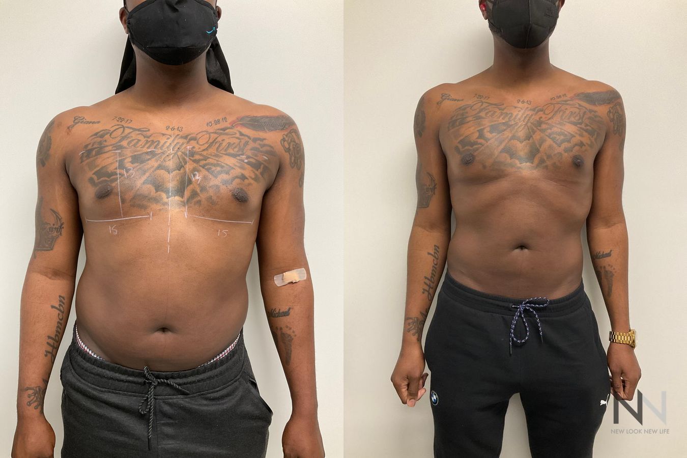 Before and after Pec Implants case 21324