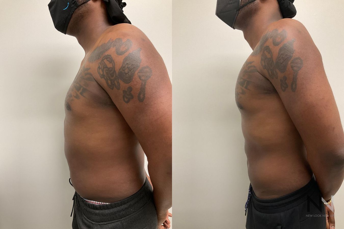 Before and after Pec Implants case 21324 - Angle 3