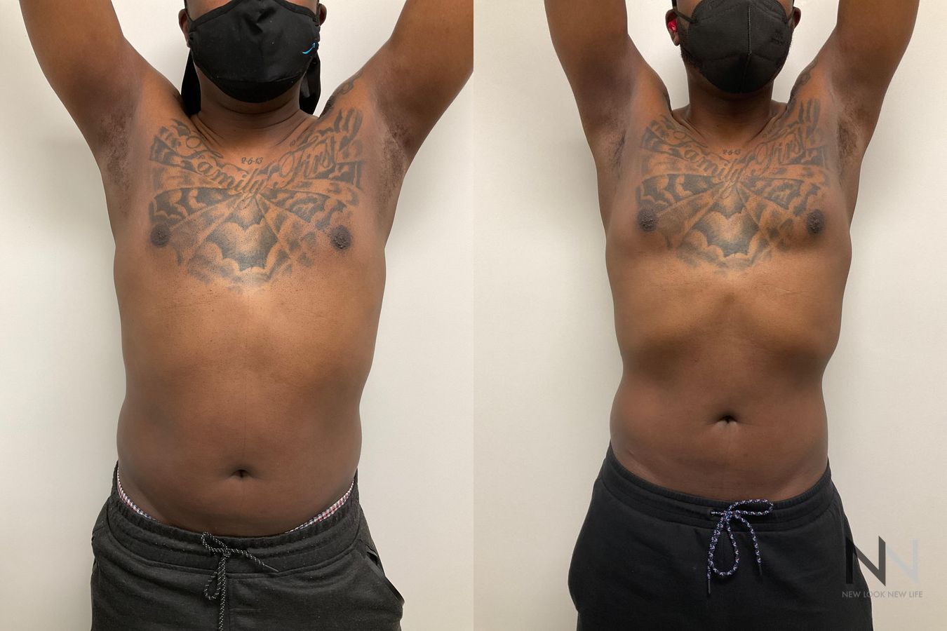 Before and after Pec Implants case 21324 - Angle 2