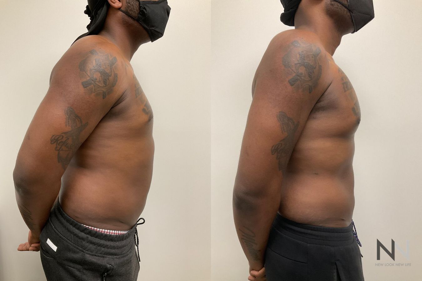 Before and after Pec Implants case 21324 - Angle 4