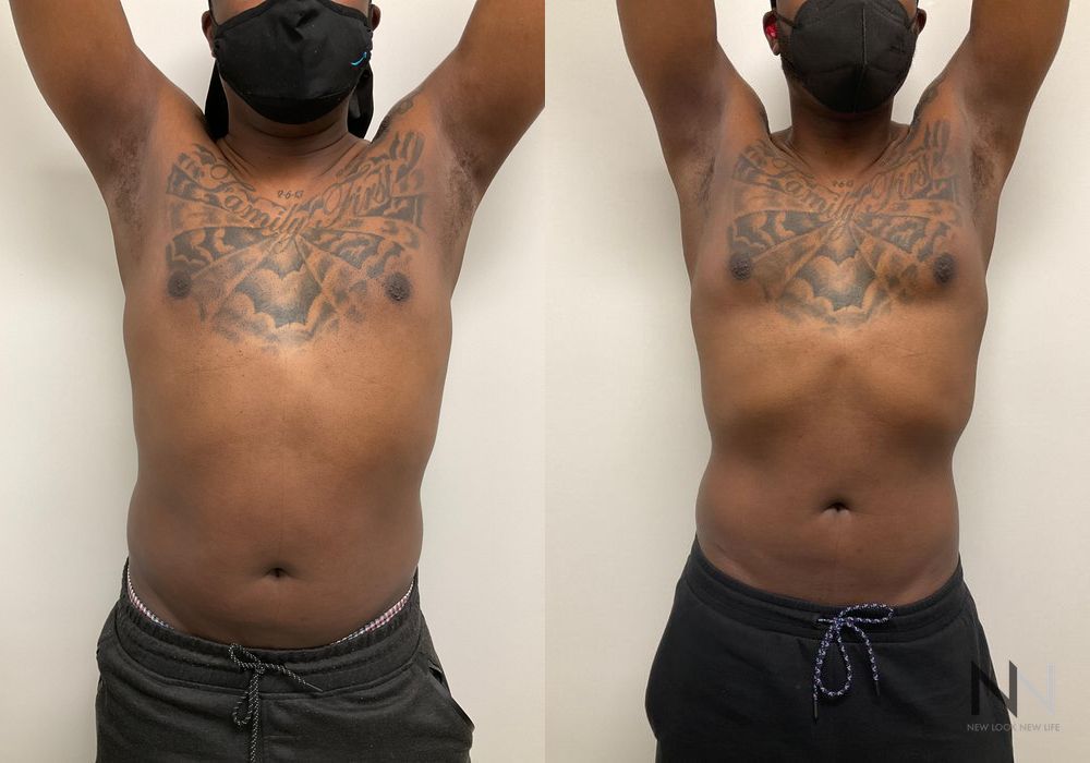 Pec Implants - Thumbnail 2