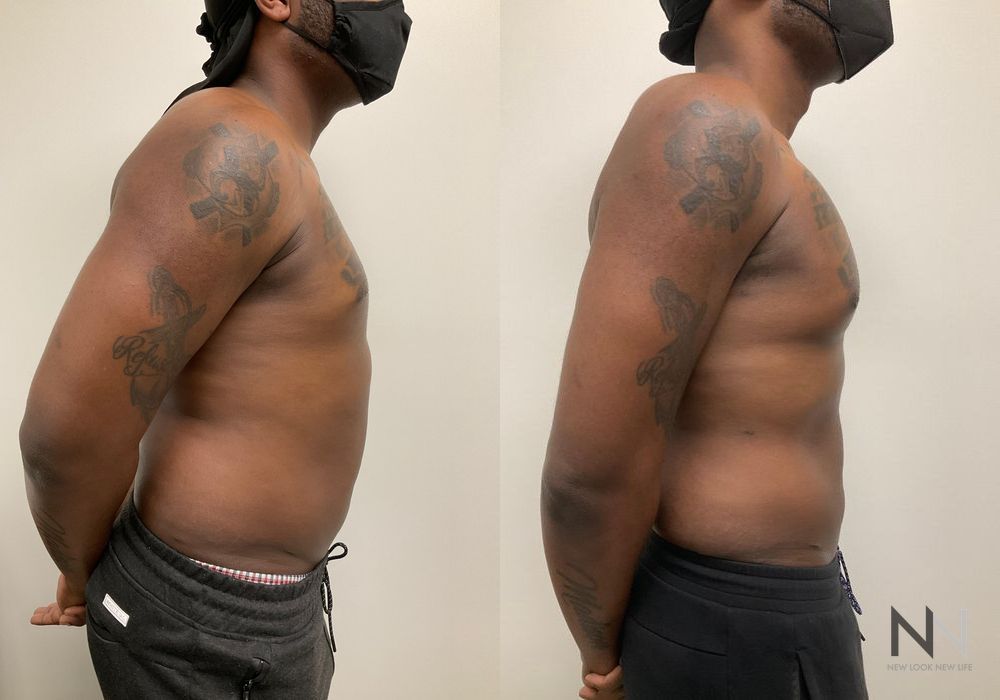 Pec Implants - Thumbnail 4