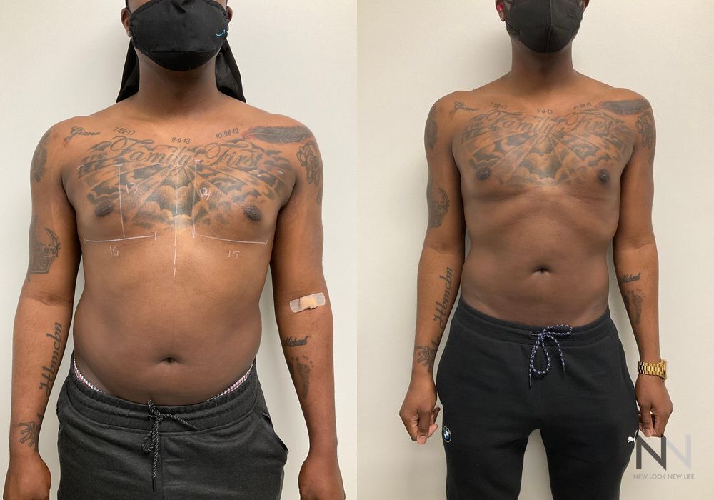 Pec Implants - Case 96