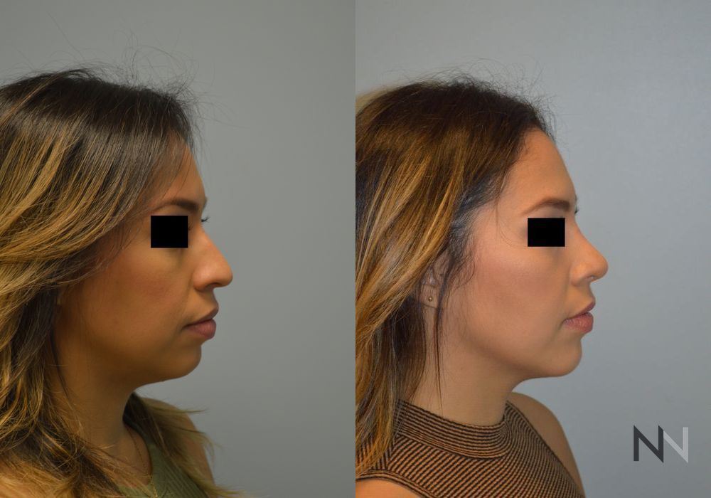 Chin Augmentation - Thumbnail 3