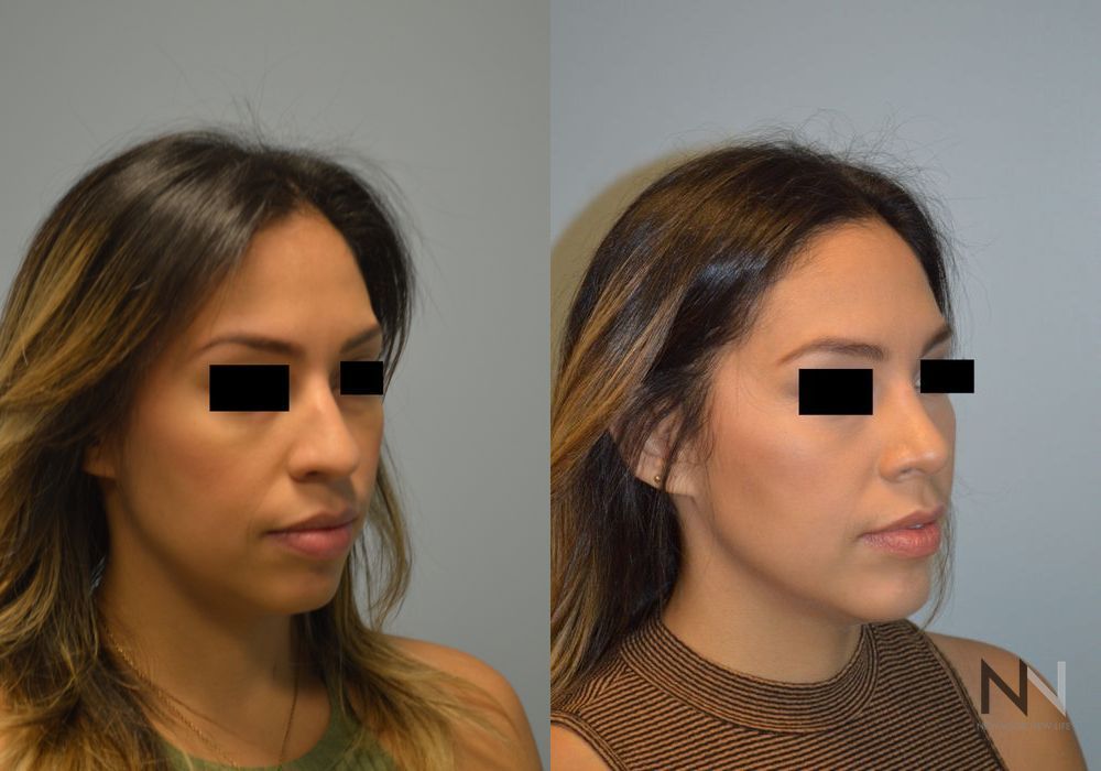 Chin Augmentation - Thumbnail 5