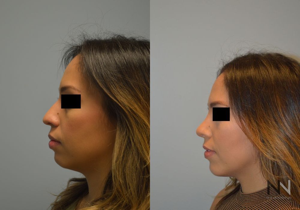 Chin Augmentation - Thumbnail 2