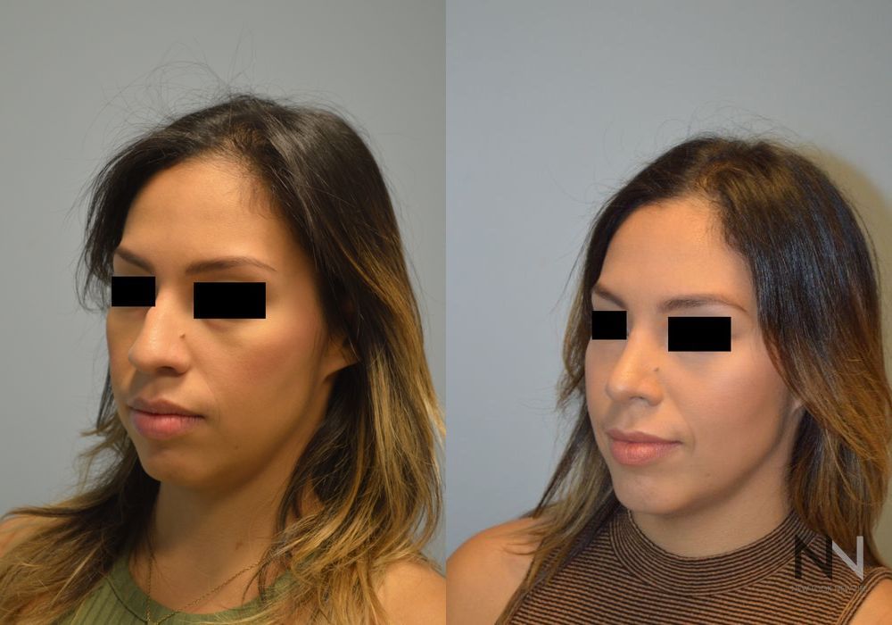 Chin Augmentation - Thumbnail 4