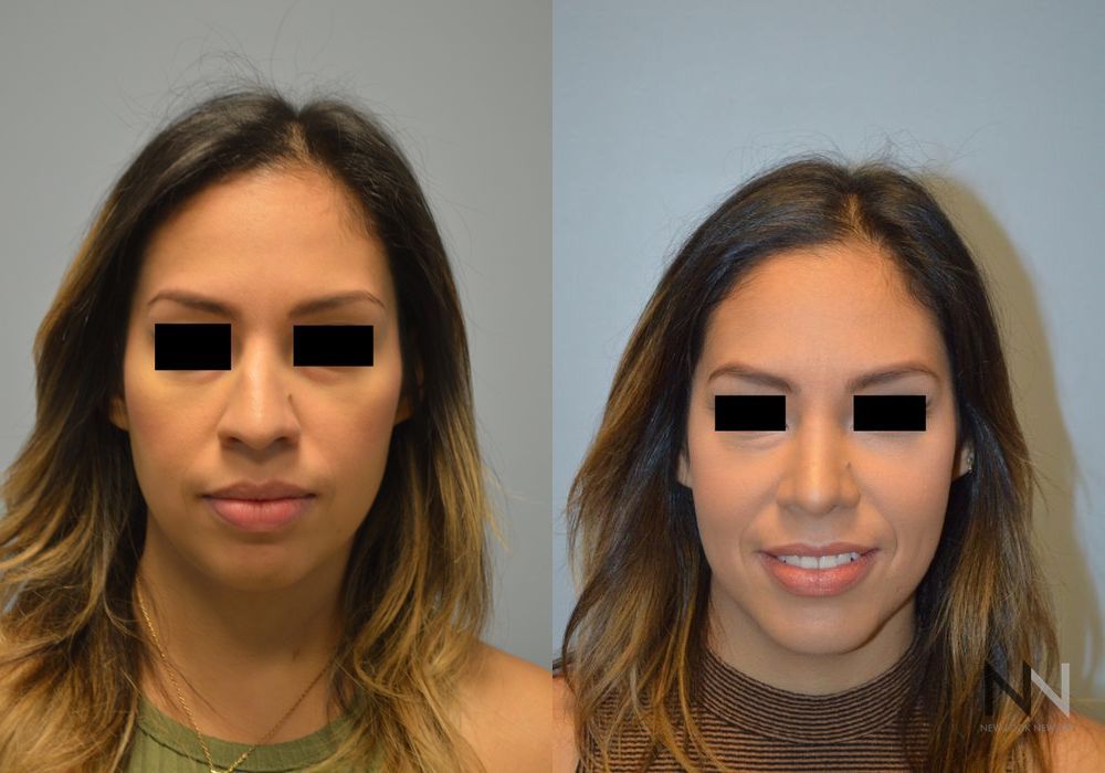 Chin Augmentation - Case 2311