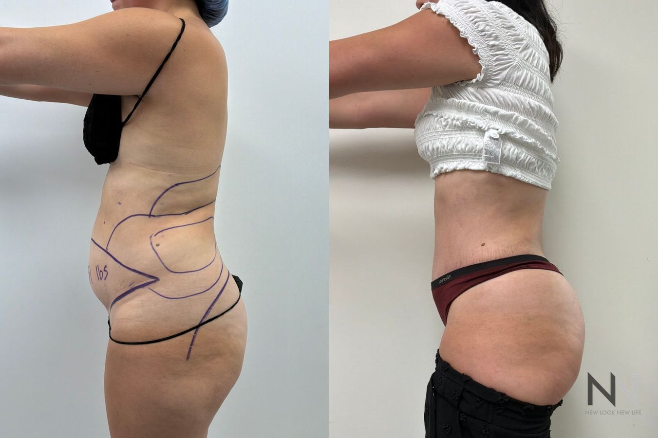 Abdominoplasty before and after showing improved abdominal contour and removal of excess skin by Dr. Claudia Kim in NYC. - Angle 3
