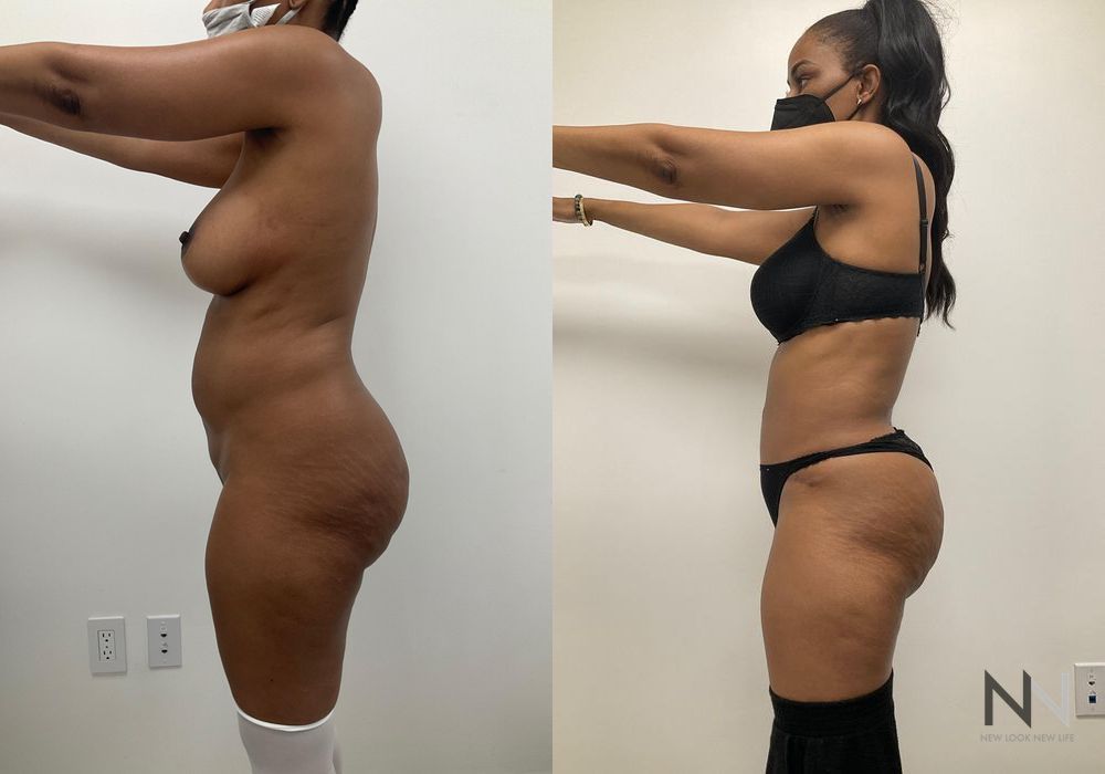 Tummy Tuck - Thumbnail 3