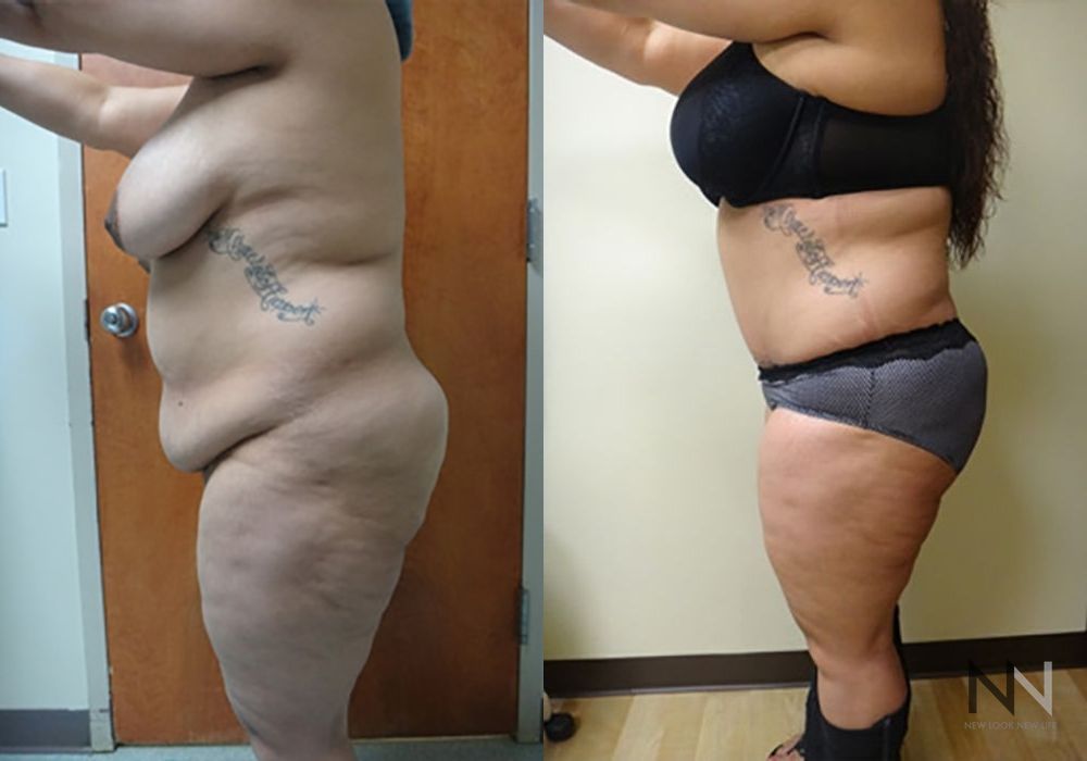 Tummy Tuck - Thumbnail 2