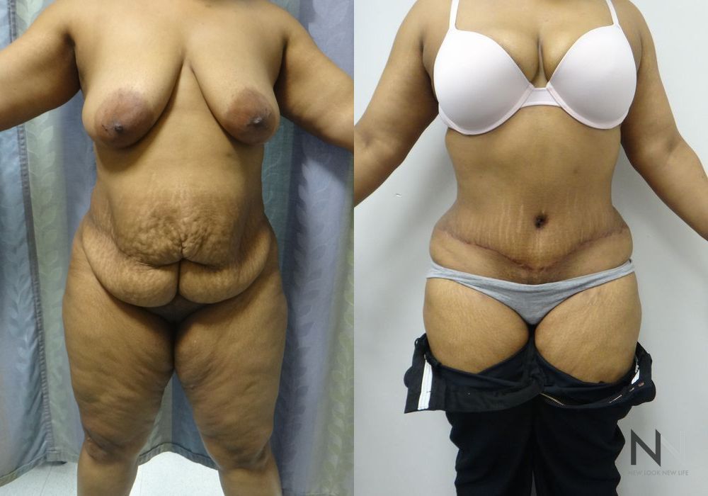 Tummy Tuck - Thumbnail 2