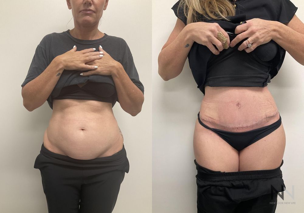 Tummy Tuck - Case 1929