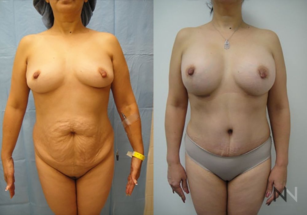 Tummy Tuck - Case 2112