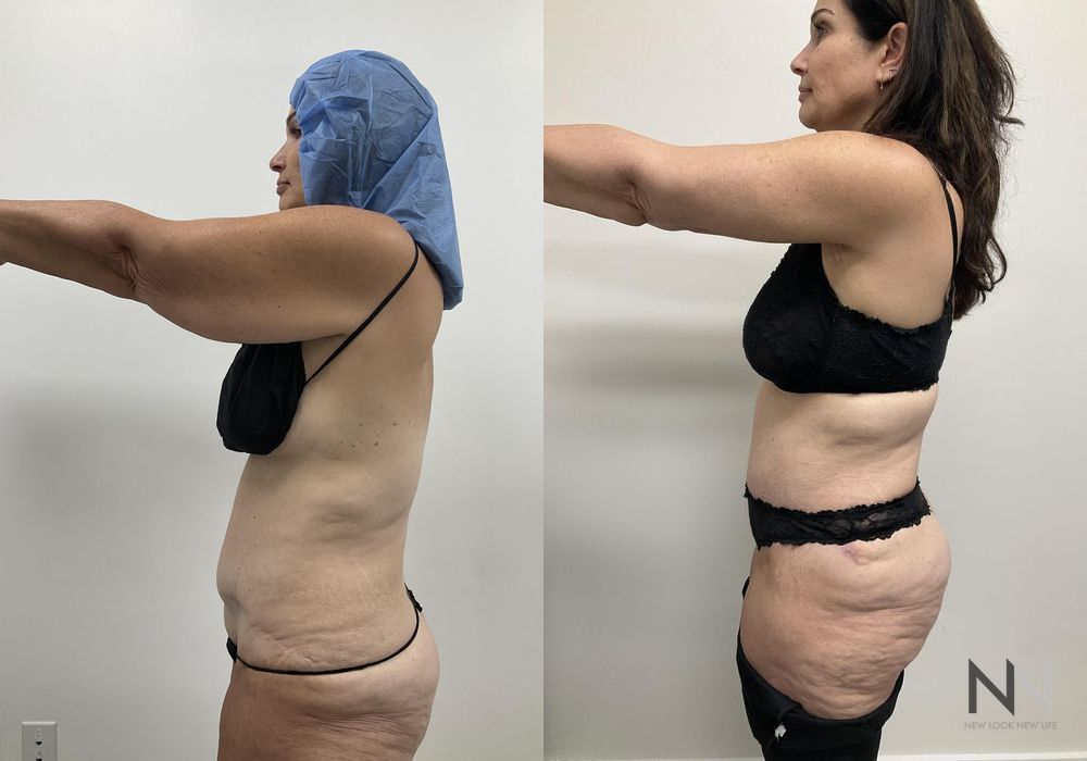 Tummy Tuck - Case 1931