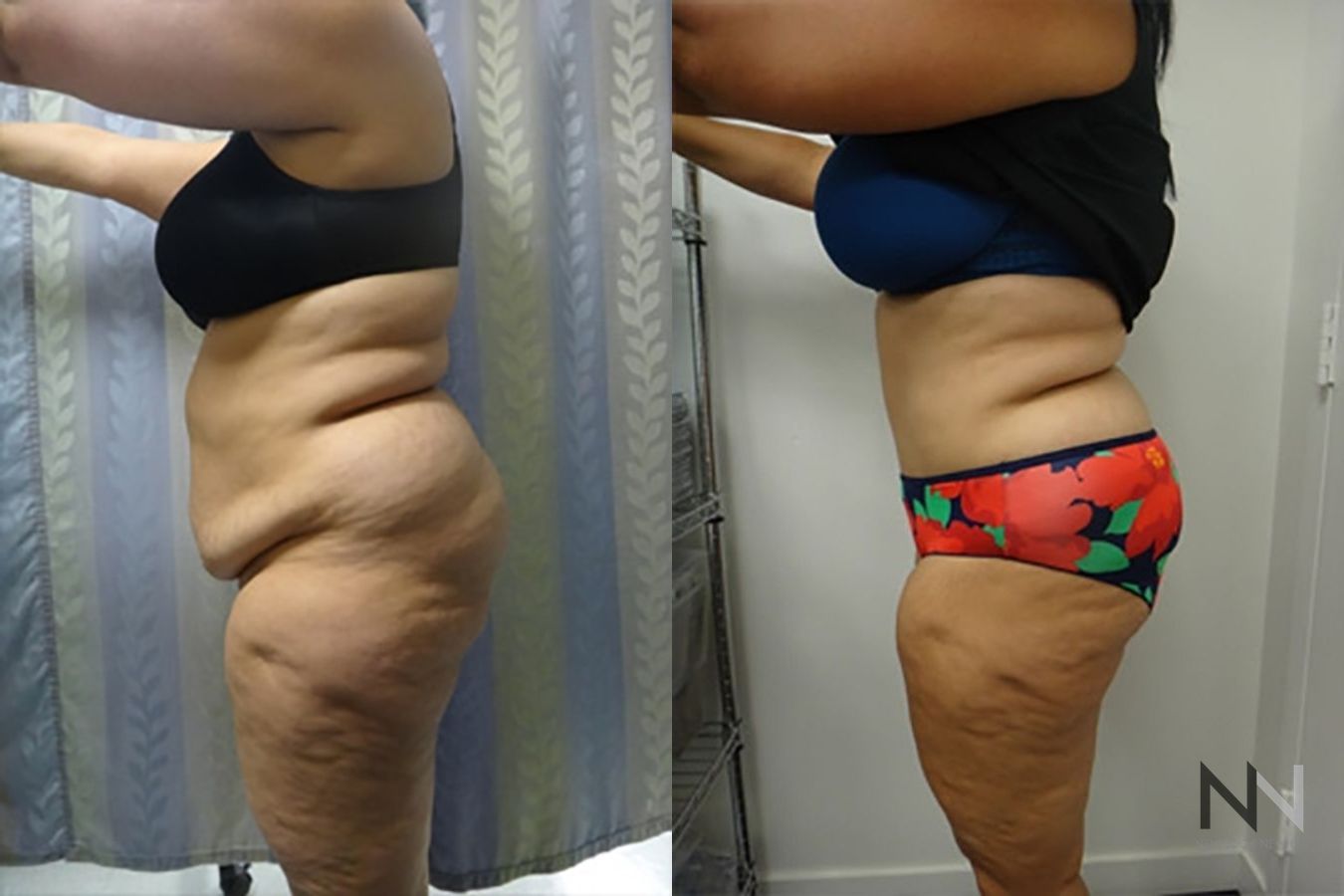 Before and after tummy tuck eight months results - Angle 2