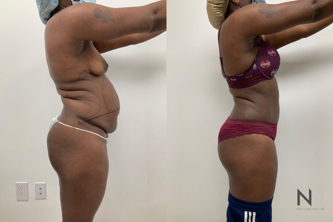 Before and after tummy tuck with liposuction six months - Angle 3