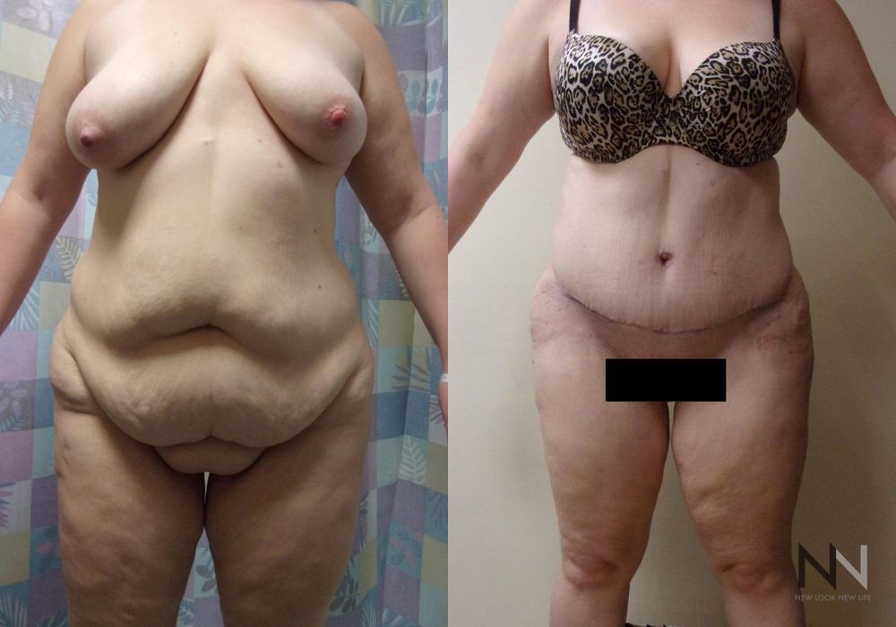 Tummy Tuck - Case 1905