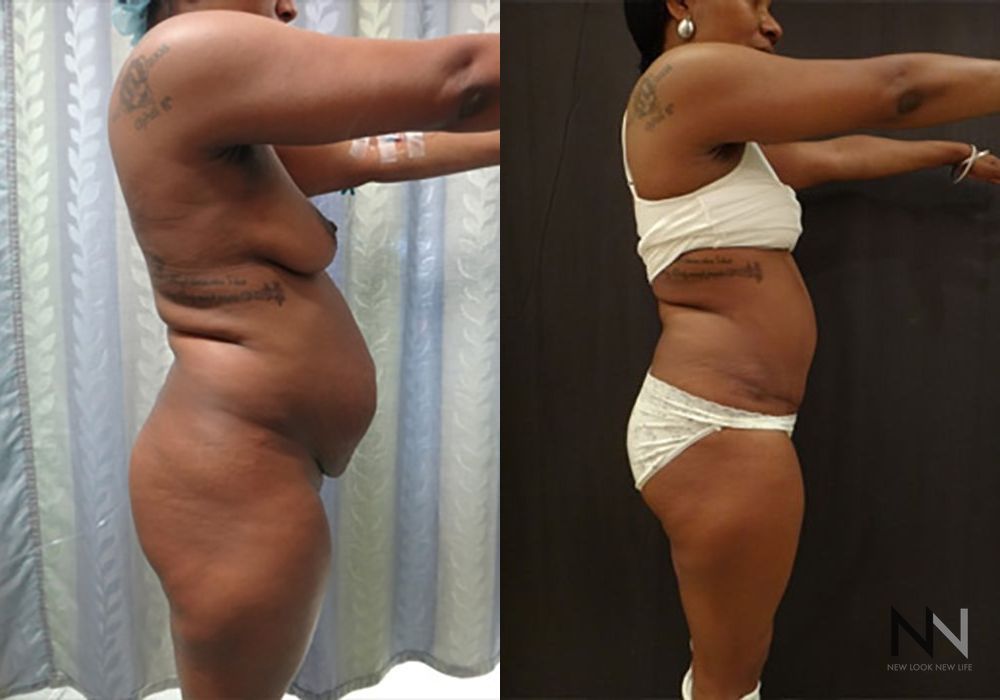 Tummy Tuck - Thumbnail 3