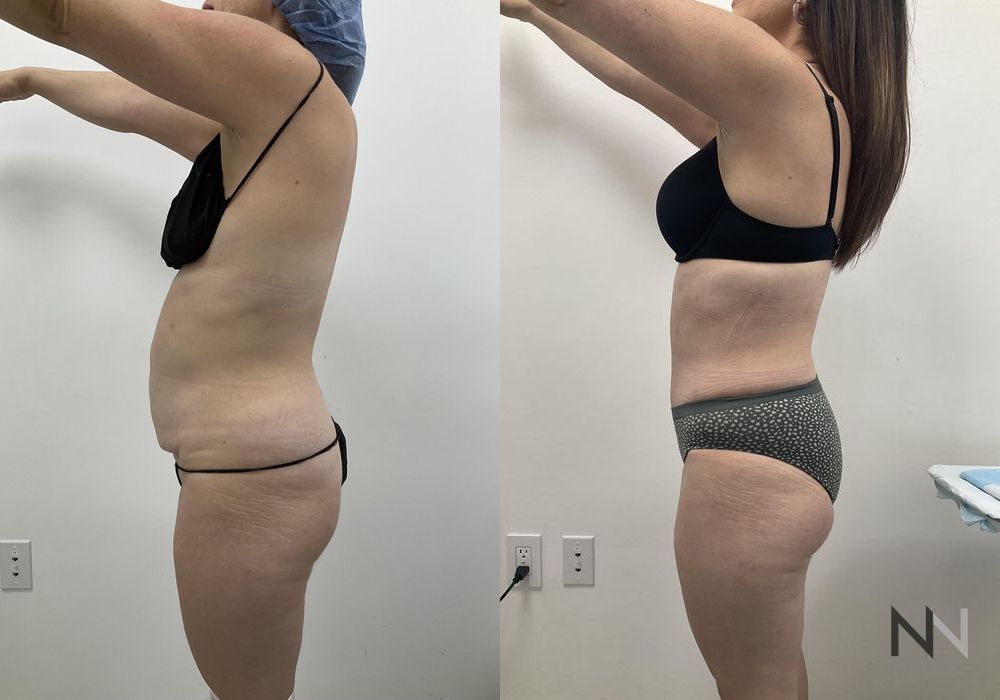 Tummy Tuck - Case 2121