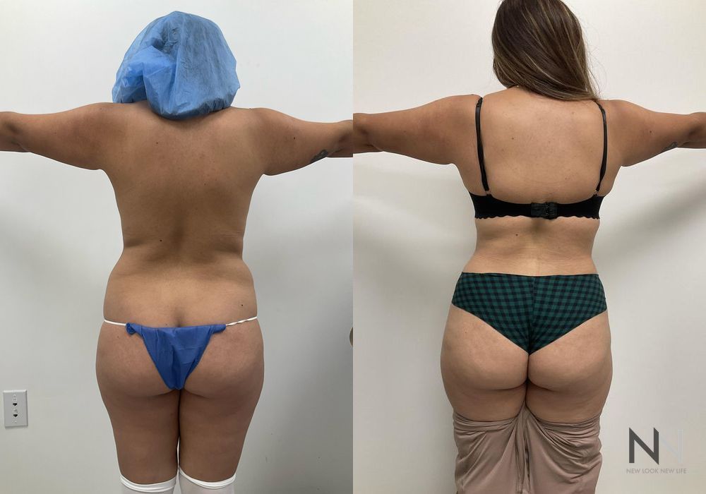 Tummy Tuck - Thumbnail 2